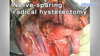 婦人科癌手術手技 Nerve-sparing radical hysterectomy  2010　ノーカット版 11分